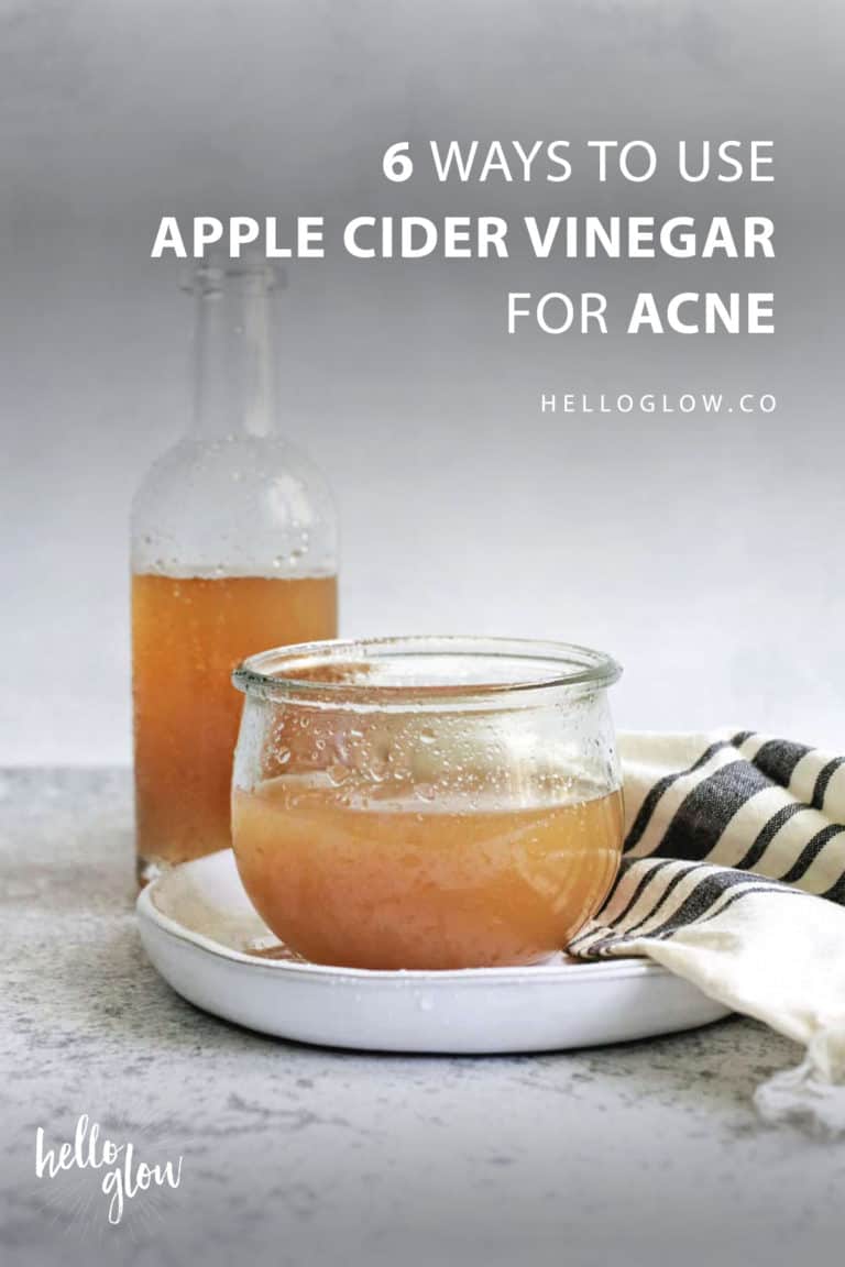 use of apple cider vinegar for acne